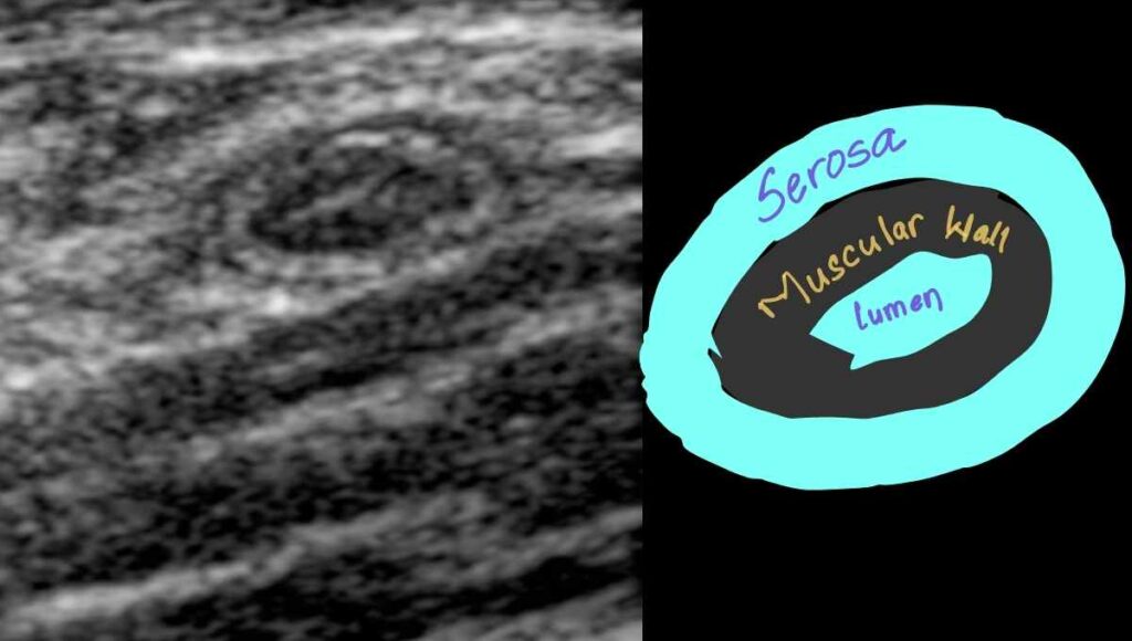 3 layers of appendix in short axis view