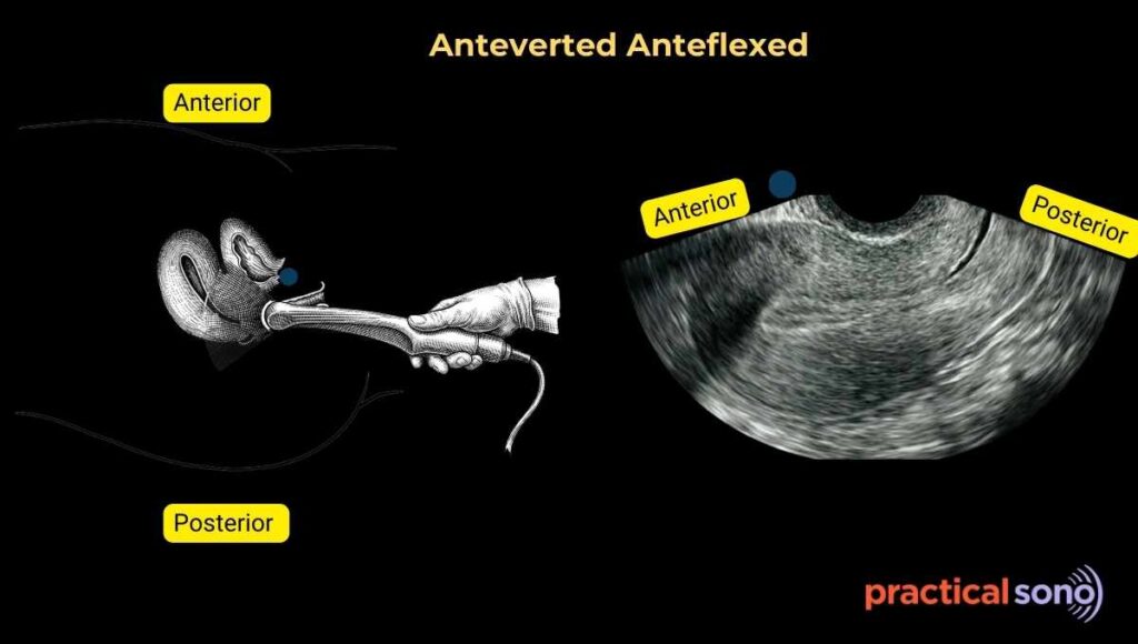 Anteverted Anteflexed pelvis seen in transvaginal scan