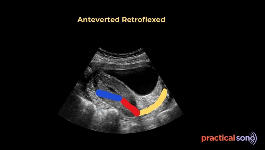 Anteverted Retroflexed uterus ultrasound