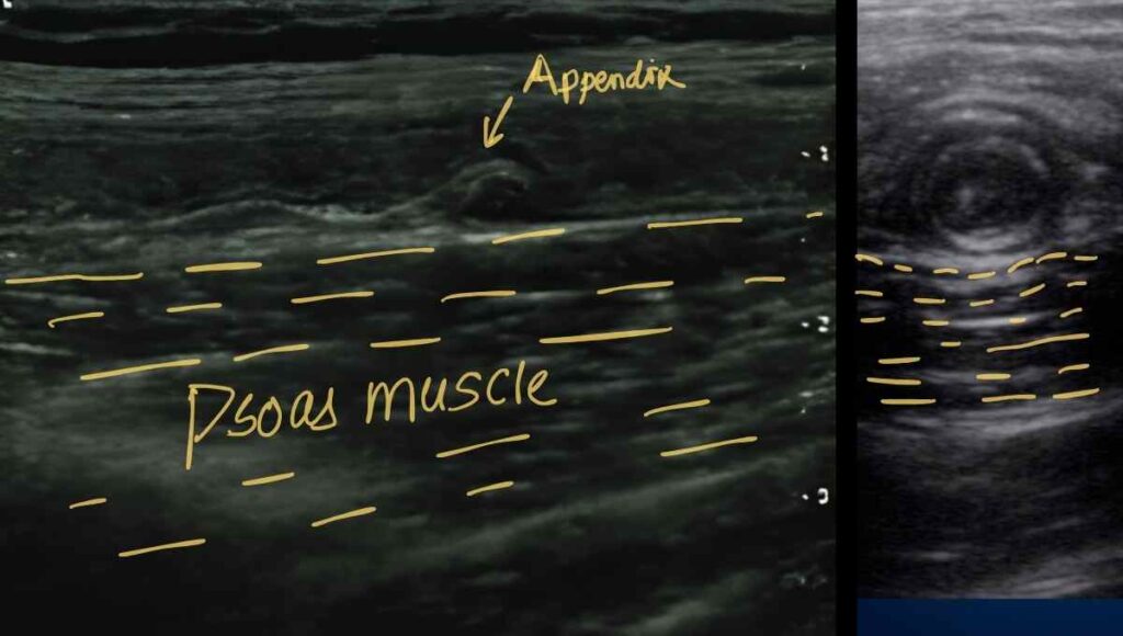 Appendix short axis view showing relationship between psoas muscle and appendix
