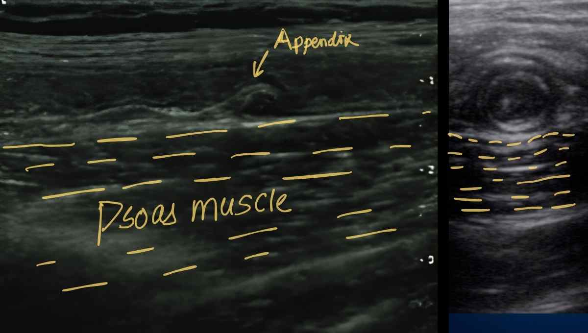Appendicitis Ultrasound Protocol - Practical Sono