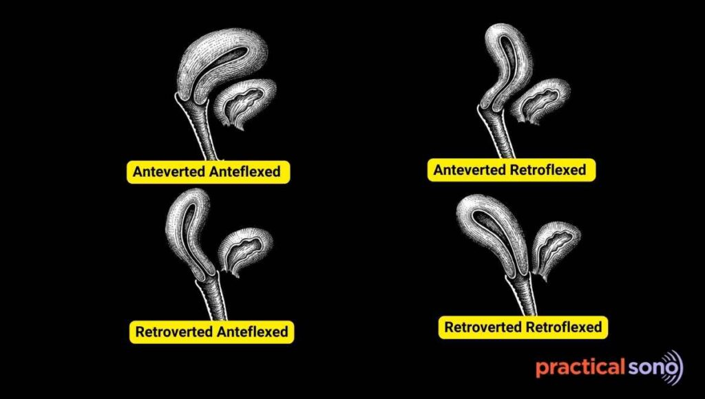 Different position of uterus
