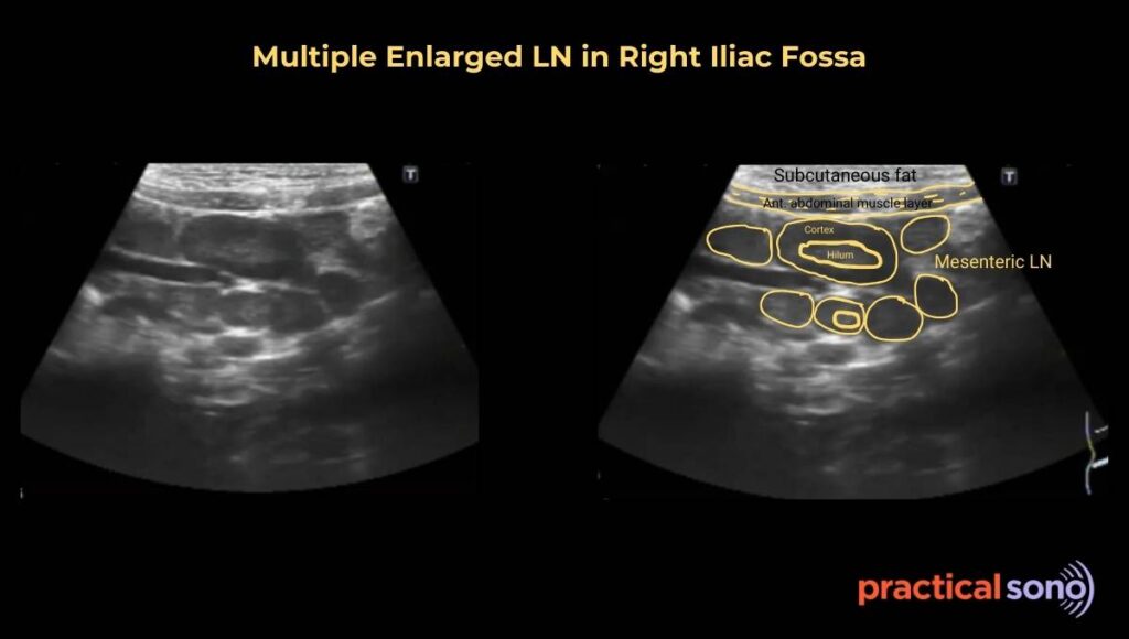 Multiple Enlarged mesenteric lymph node in Right Iliac Fossa