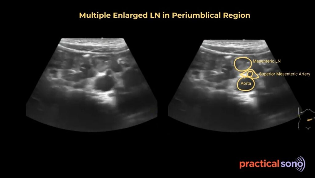 Multiple Enlarged mesenteric lymph node in periumbilical region