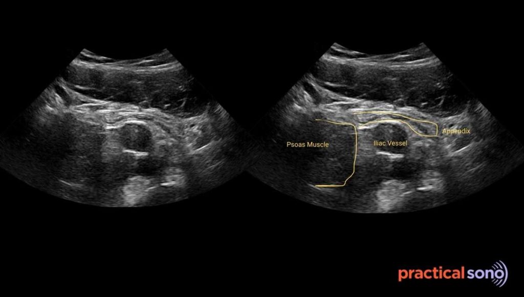 Normal appendix ultrasound image