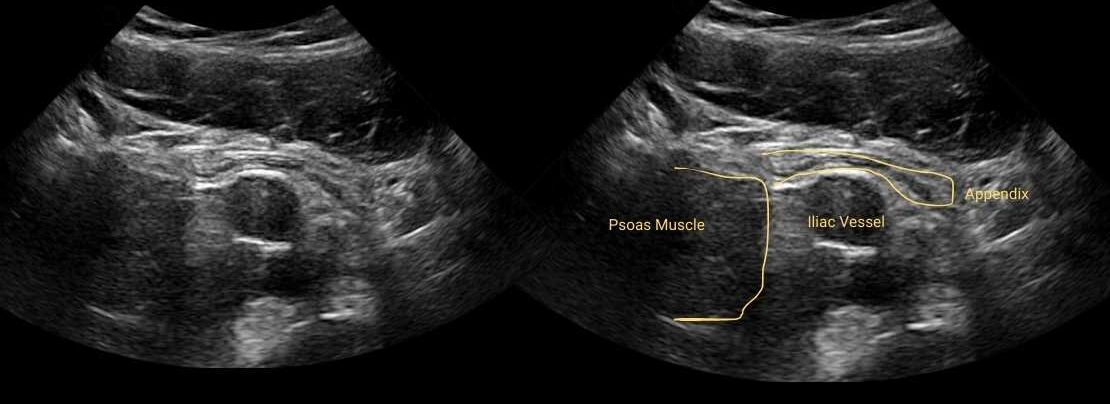 Normal appendix ultrasound image