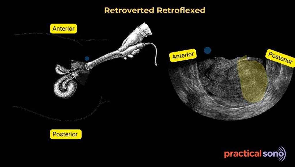 Retroverted Retroflexed pelvis seen in transvaginal scan