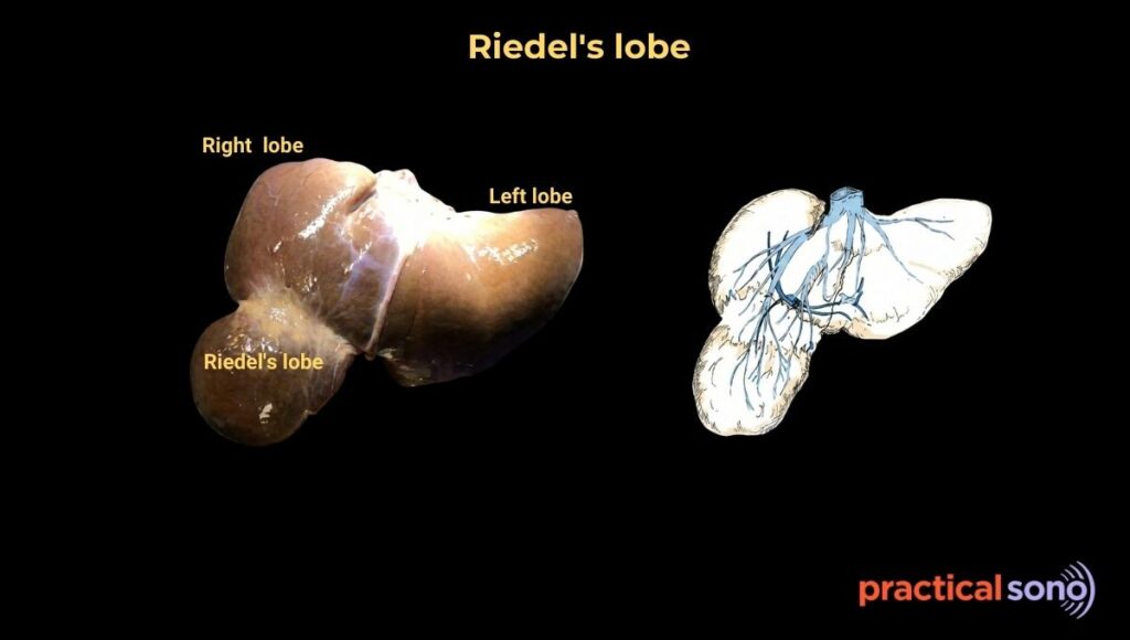 Riedel's lobe