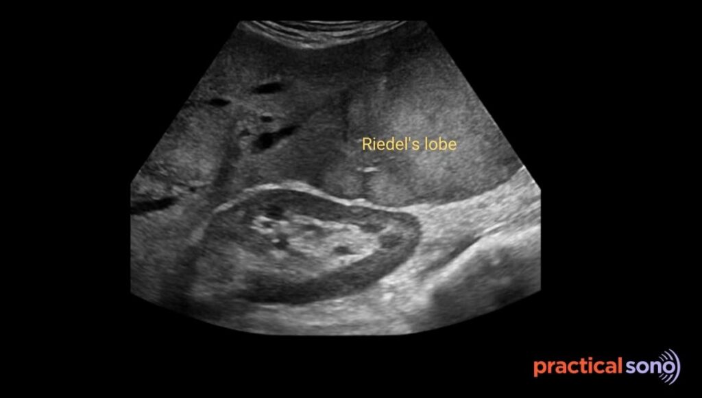 Riedel's lobe ultrasound