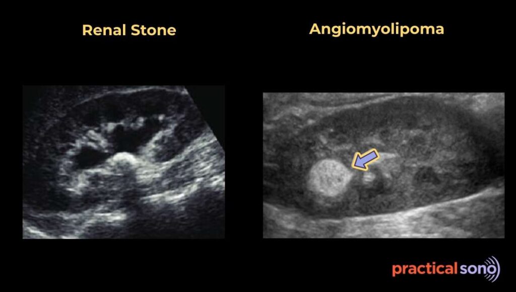 angiomyolipoma ultrasound
