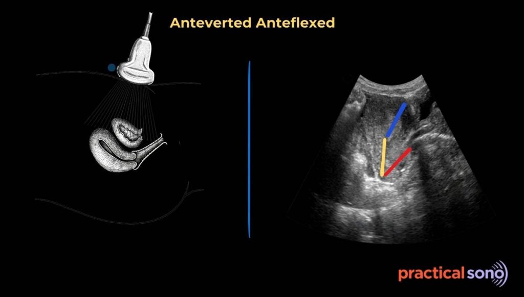 anteverted anteflexed