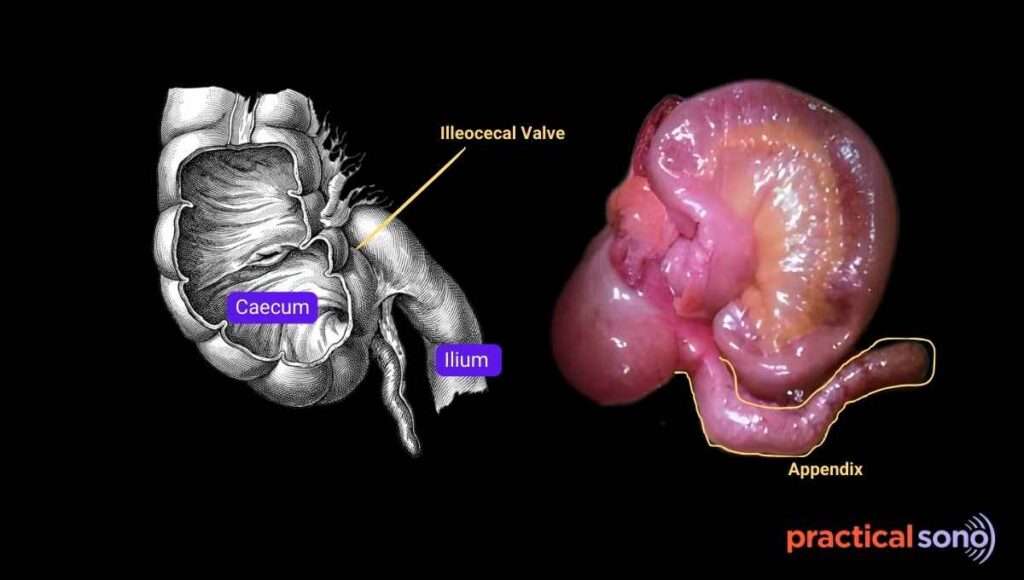 appendix origin at caecum 