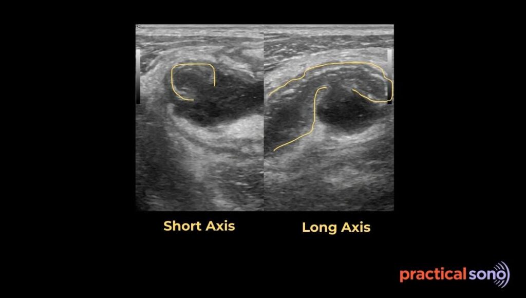 appendix perforation ultrasound image