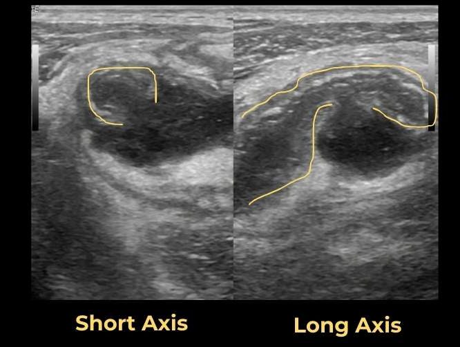 appendix perforation ultrasound image