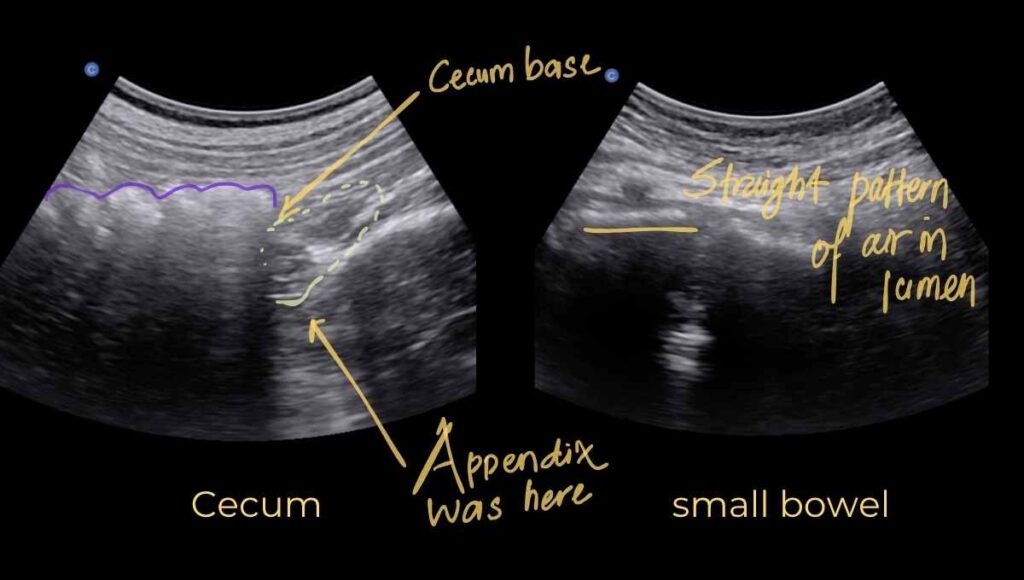 cecum vs small bowel how to to recognize cecum in ultrasound
