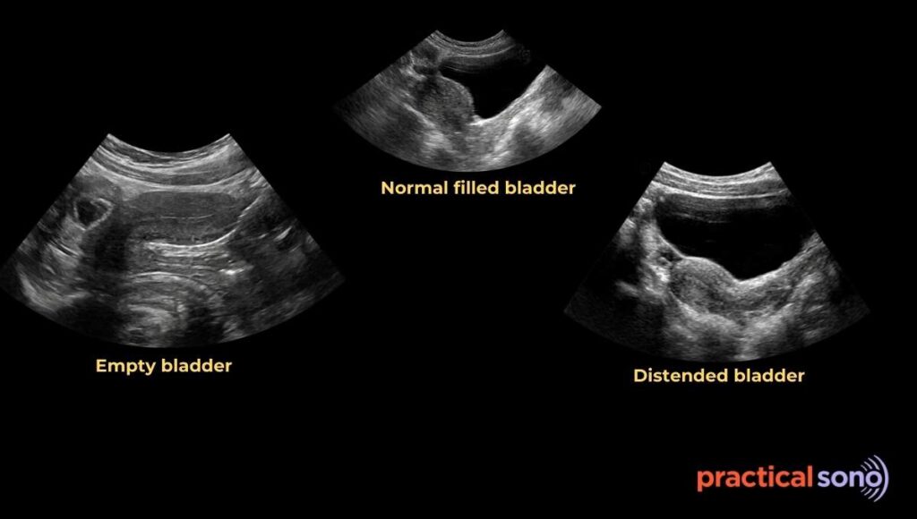 change in position of uterus with bladder size