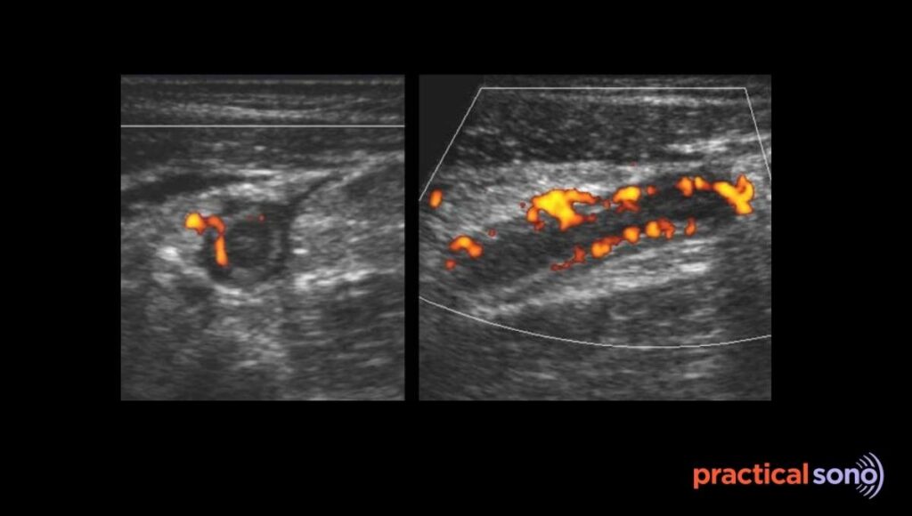color doppler finding in appendicitis