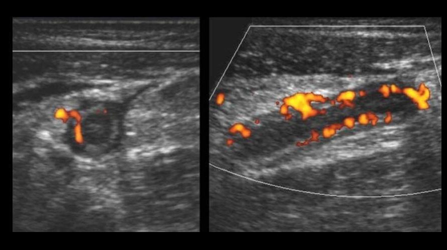 color doppler finding in appendicitis