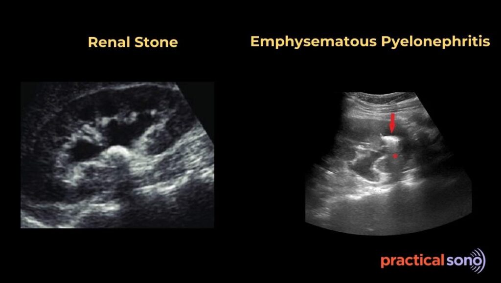 emphysematous pyelonephritis ultrasound