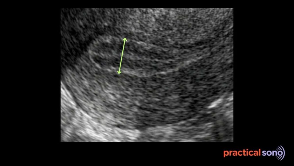 endometrial thickness measurement technique demonstration in ultrasound