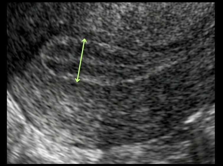 endometrial thickness measurement technique demonstration in ultrasound
