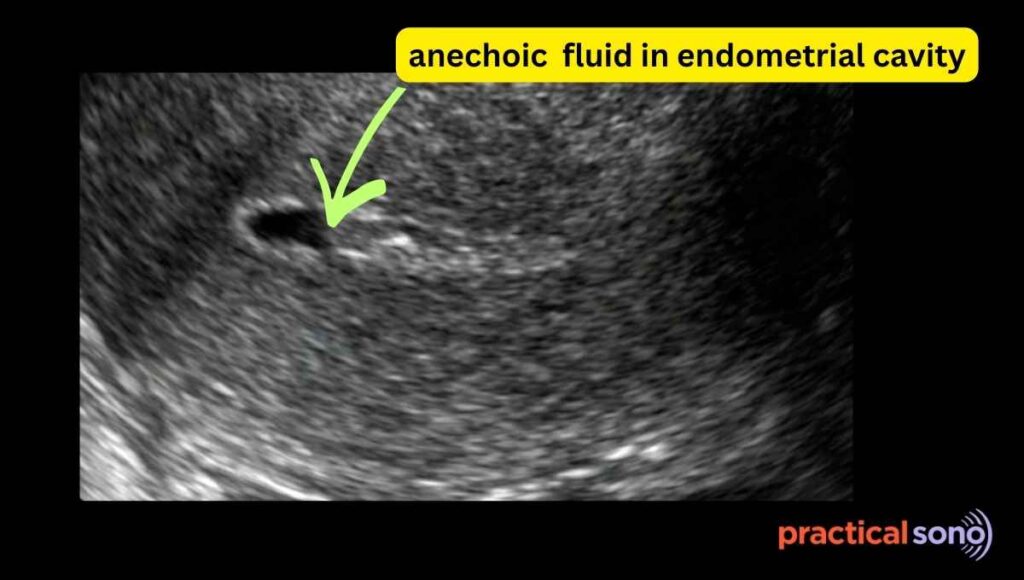 endometrial cavity fluid