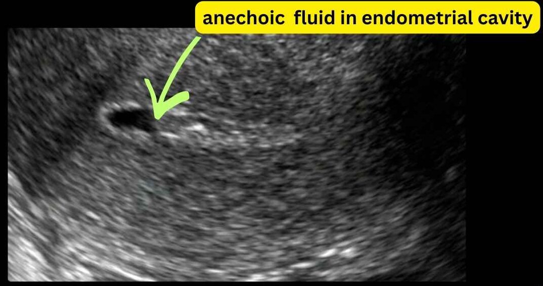 endometrial cavity fluid