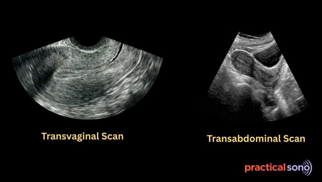 endometrium appearance in transvaginal and transabdominal scan