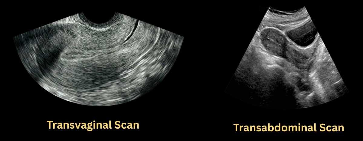 endometrium appearance in transvaginal and transabdominal scan