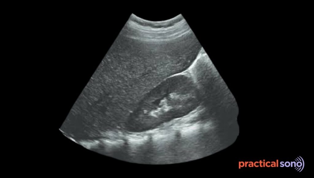 enlarged liver ultrasound images
