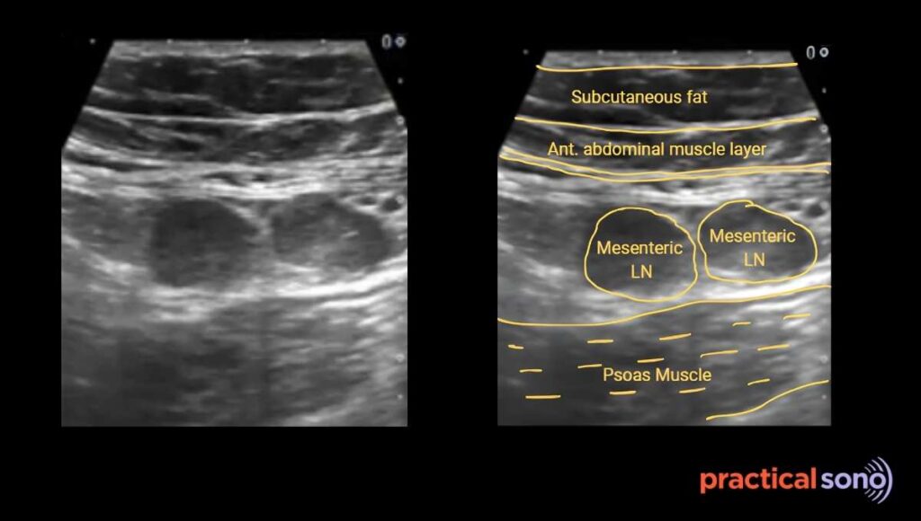 enlarged mesenteric lymph node in right iliac fossa ultrasound image