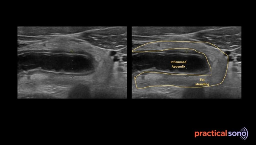fat stranding in appendicitis ultrasound image