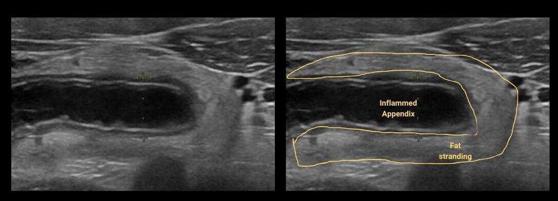 fat stranding in appendicitis ultrasound image