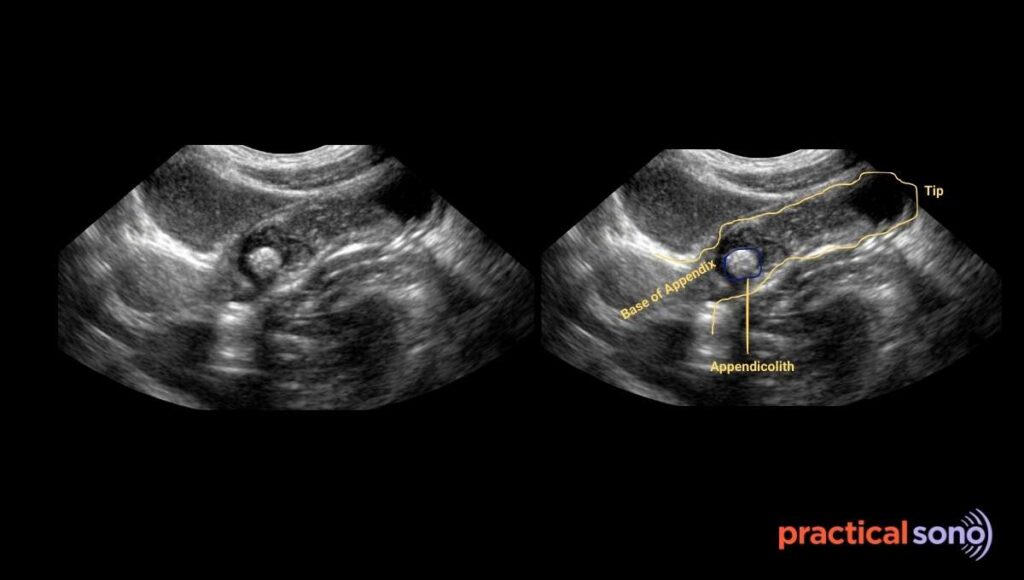 fecolith of appendix ultrasound image