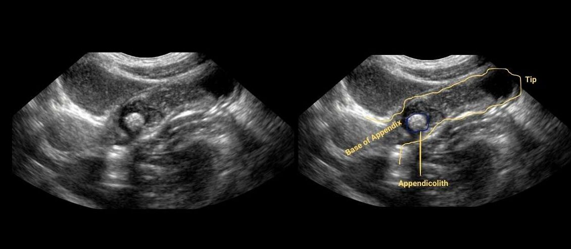 fecolith of appendix ultrasound image