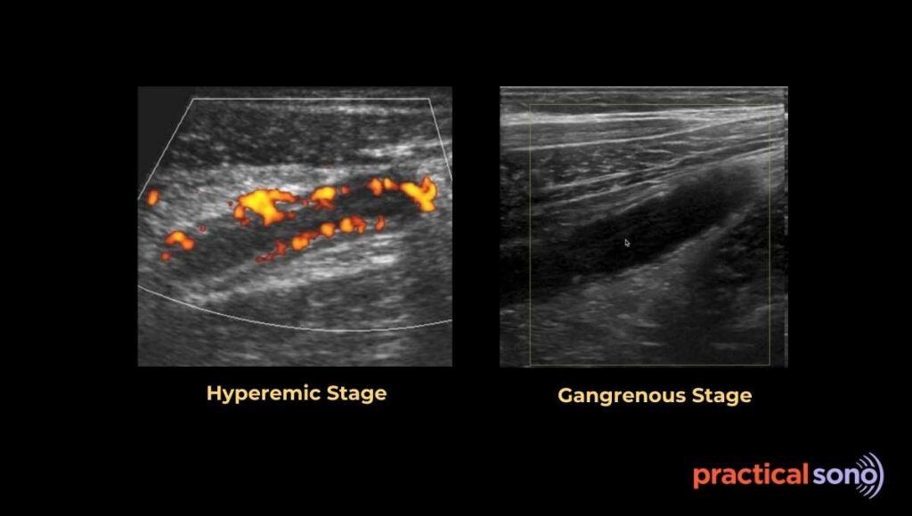gangrenous appendicitis color doppler finding ultrasound image