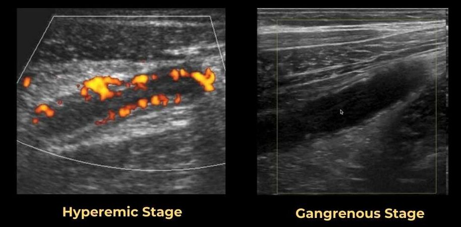 gangrenous appendicitis color doppler finding ultrasound image