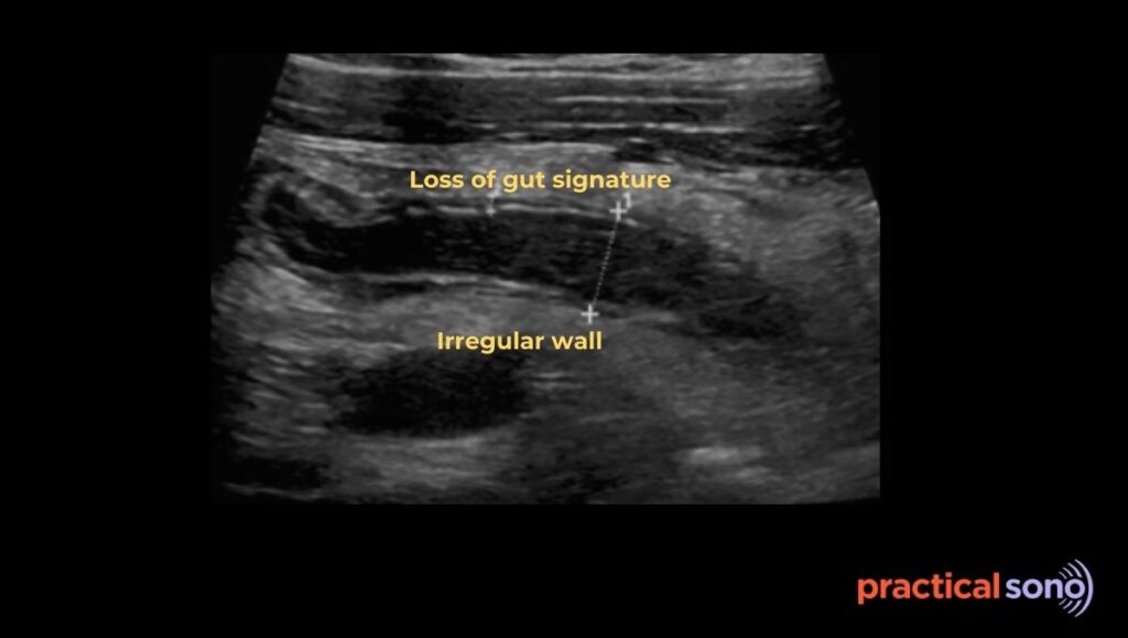 gangrenous appendicitis ultrasound image