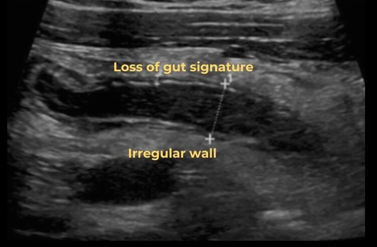 gangrenous appendicitis ultrasound image