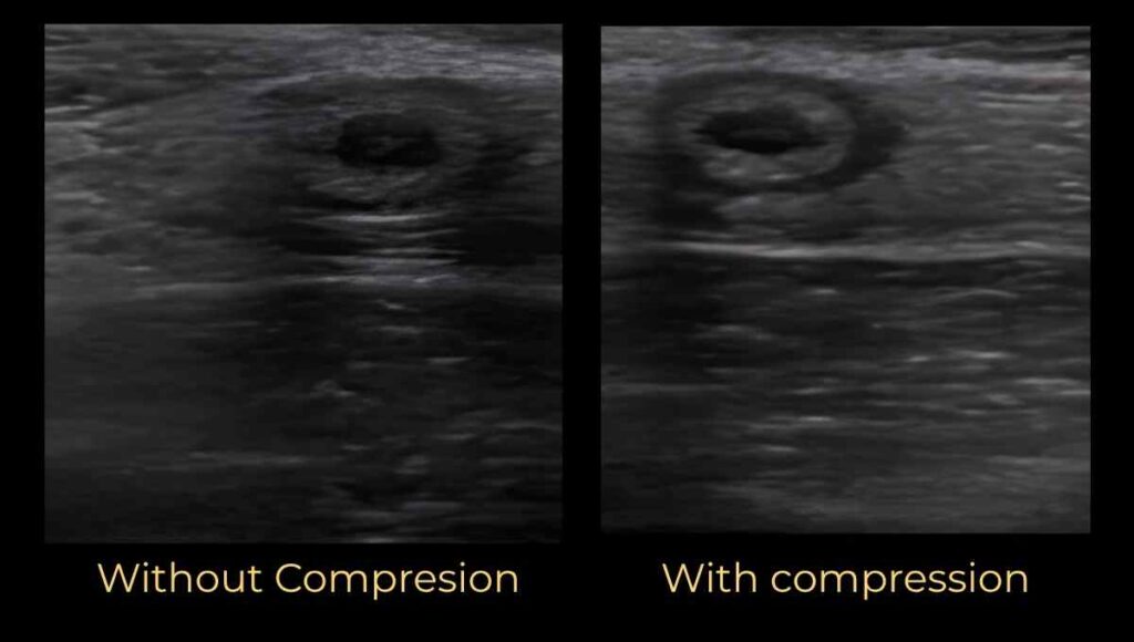 graded compression