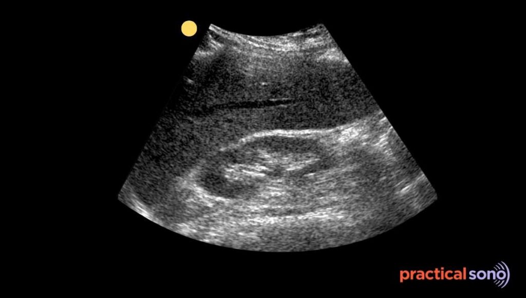 hepatomegaly ultrasound