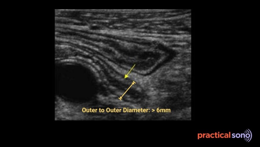 increased outer wall to outer wall diameter in appendicitis