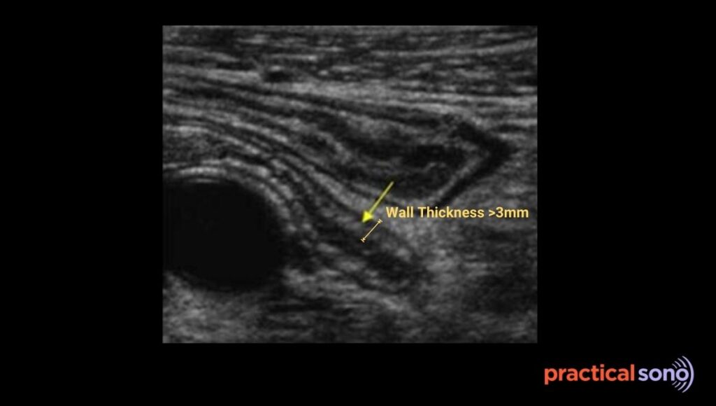 increased wall thickness in appendicitis