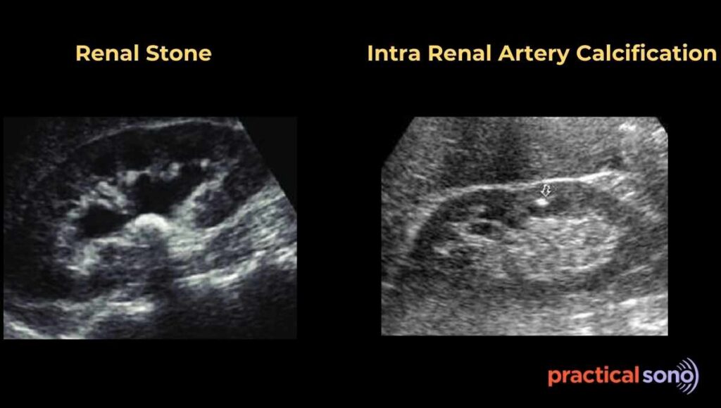 intra renal artery calcification ultrasound