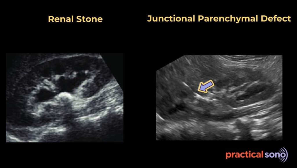 junctional parenchymal defect ultrasound