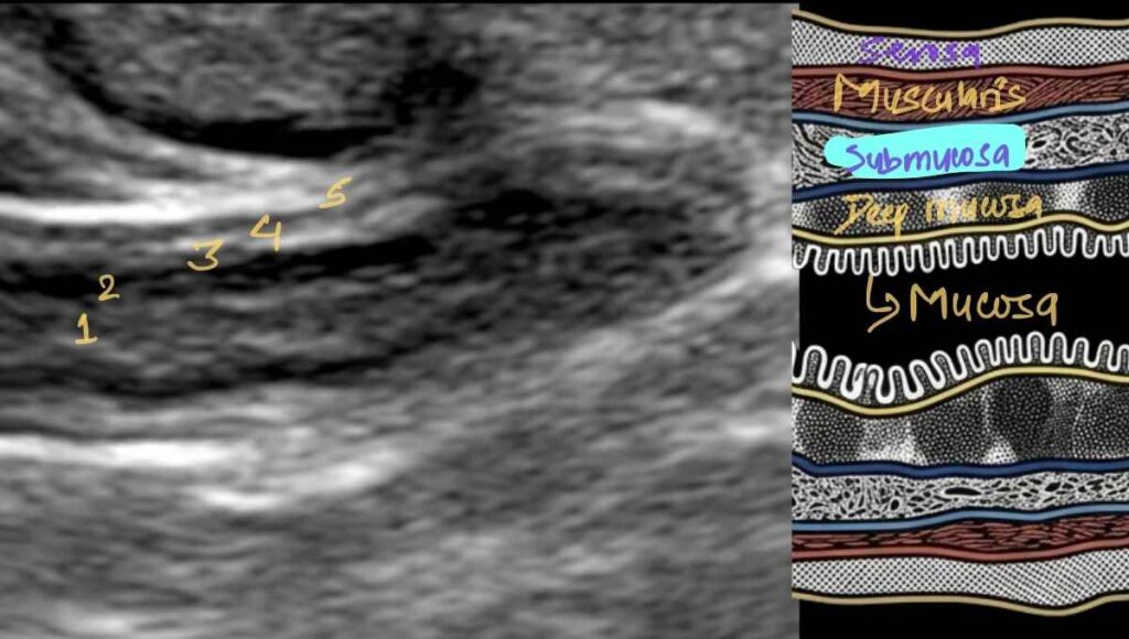 layers of appendix in long axis view