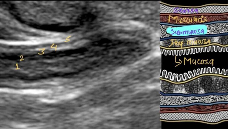 Appendicitis Ultrasound Protocol - Practical Sono
