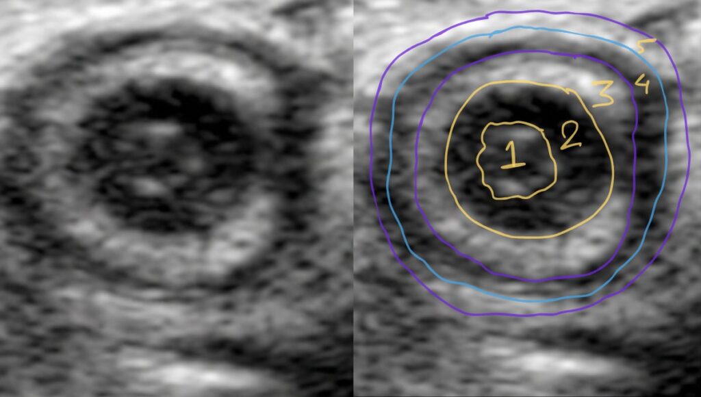 layers of appendix in short axis view