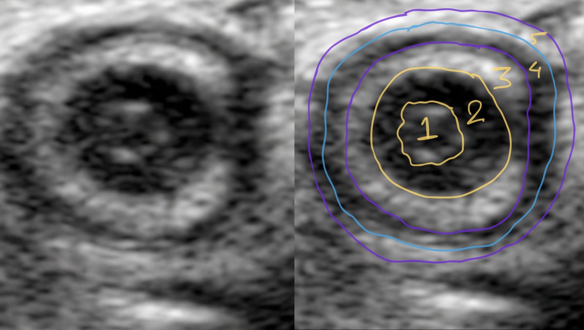 Appendicitis Ultrasound Protocol - Practical Sono