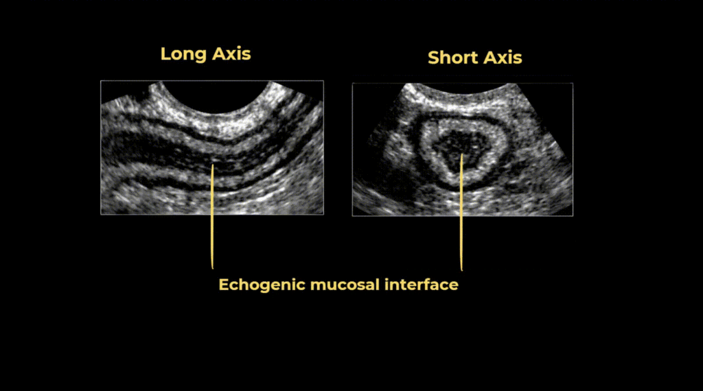Gut Signature of the Appendix seen in ultrasound
